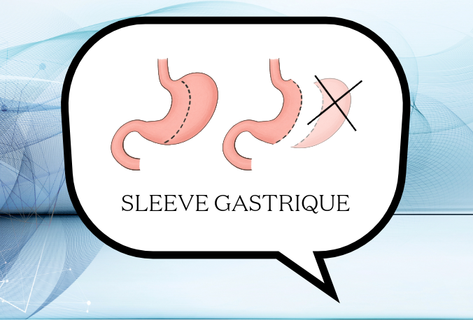 Dessin d'une sleeve gastrique